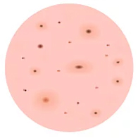 Types of acne: representation of blackheads