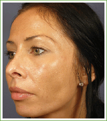 Chemical Peel, Vi peel, Acne Treatment long island great neck