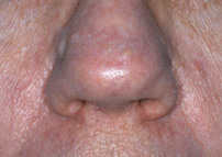 vein removal nose after white plains stamford