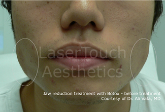 Jaw reduction with Botox - before treatment brooklyn