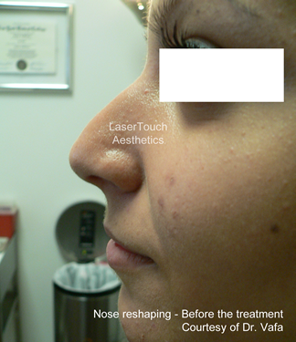 nose reshaping before white plains westchester