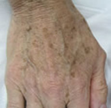 hands freckle treatment white plains scarsdale
