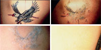 tattoo removal photo white plains scarsdale