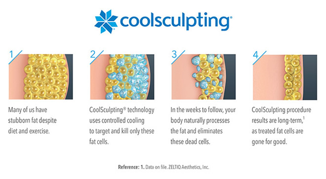 coolsculpting double chin reduction long island oyster bay