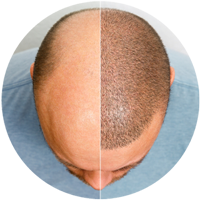 post care instructions for hair transplant