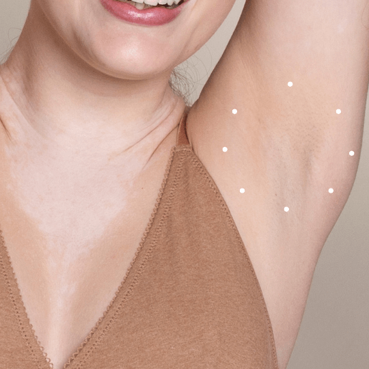 botox for sweat reduction underarm
