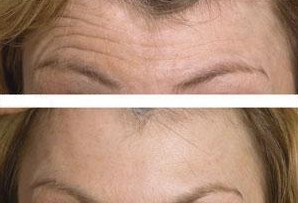 Botox forehead lines Long Island great neck