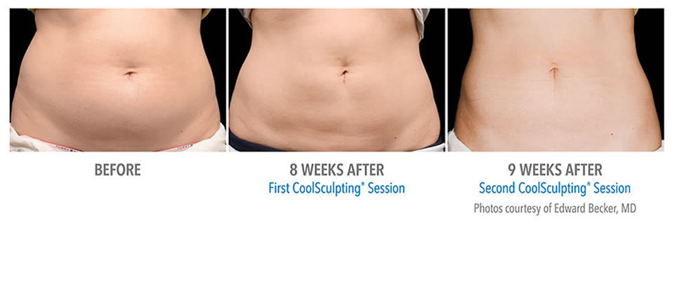 coolsculpting before after Morristown