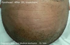 forehead freckle removal after IPL white plains stamford