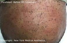 forehead freckle removal IPL Larchmont