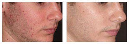 Acne treatment before and after brooklyn dumbo