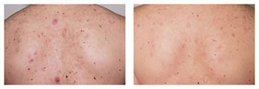 Acne treatment before and after white plains stamford