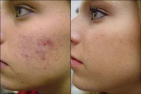 active acne inflammation laser treatment