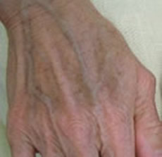 hands freckle treatment nyc